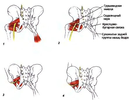 Седалищный нерв где расположен фото