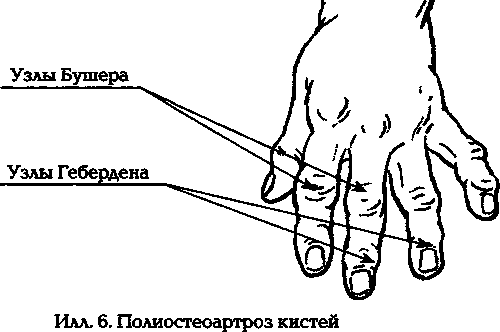 Онемение