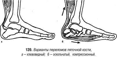 Перелом свода стопы фото