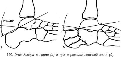 Перелом пяточной кости карта вызова